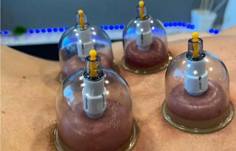 Cupping y ventosas para relajación y bienestar